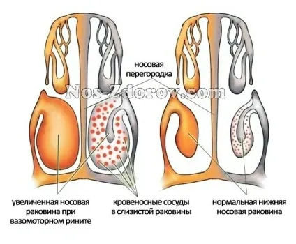 Підслизова вазотомія нижніх носових раковин види, фото, відео, відгуки (носових) Підслизова вазотомія нижніх носових раковин види, фото, відео, відгуки