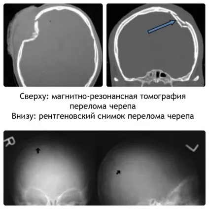 За якими ознаками здогадатися, що стався перелом черепа і як надати першу долікарську допомогу (першу) За якими ознаками здогадатися, що стався перелом черепа і як надати першу долікарську допомогу