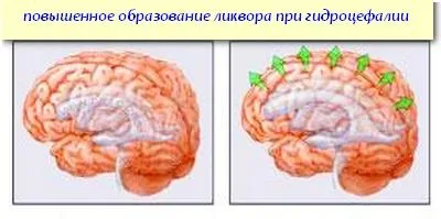 Підвищений внутрішньочерепний тиск у немовлят, зайплюшкі