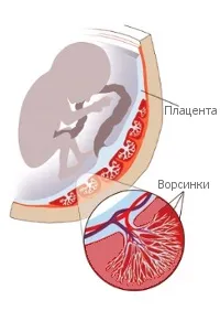 Передчасне старіння плаценти