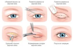 Причини нависання століття