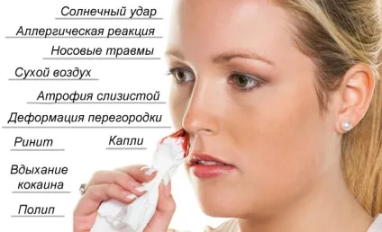 Причини крові з носа у дорослих і дітей, разове і регулярне (дорослих) Причини крові з носа у дорослих і дітей, разове і регулярне