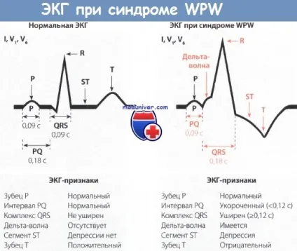 Ознаки синдрому Вольфа-Паркінсона-Уайта (wpw) на ЕКГ (великим зубцем відведенні) Ознаки синдрому Вольфа-Паркінсона-Уайта (wpw) на ЕКГ
