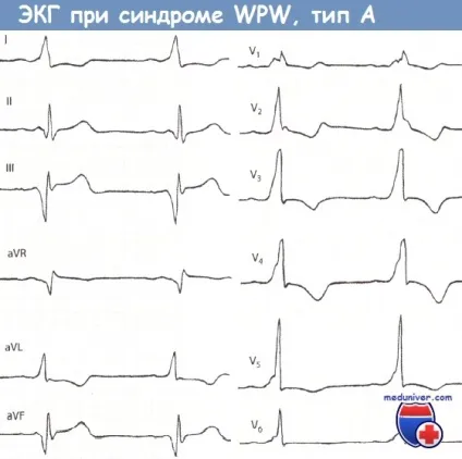 Ознаки синдрому Вольфа-Паркінсона-Уайта (wpw) на ЕКГ (Вольфа-Паркінсона-Уайта) Ознаки синдрому Вольфа-Паркінсона-Уайта (wpw) на ЕКГ