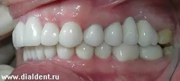 Протезування зубів, реконструкція прикусу (протезування) Протезування зубів, реконструкція прикусу