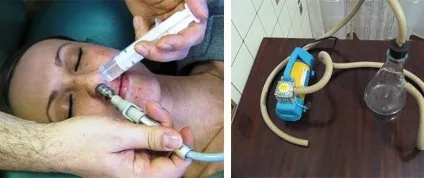 Процедура зозуля при гаймориті як роблять в домашніх умовах (домашніх) Процедура зозуля при гаймориті як роблять в домашніх умовах
