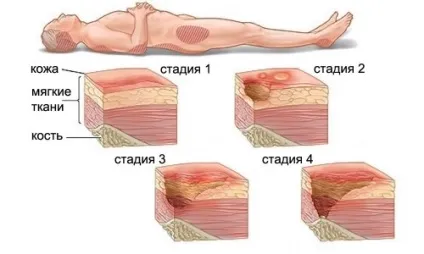 Протипролежневі матраци види, інструкція із застосування, як вибрати і користуватися