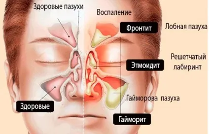 Процедура промивання носа при гаймориті - зозуля відео методу та відгуки