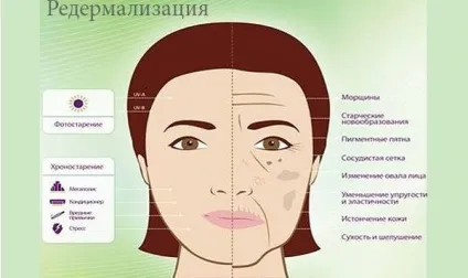 Редермалізація що це, показання, протипоказання (косметологія хірургія пластика) Редермалізація що це, показання, протипоказання