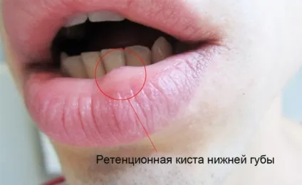 Ретенційна кіста нижньої губи - що це таке (нижньої) Ретенційна кіста нижньої губи - що це таке
