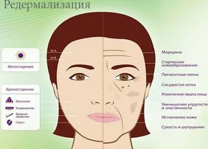 Редермалізація шкіри обличчя ін'єкції Гіалуаль