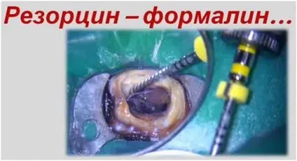 Резорцин-формалін зуб лікувався, резорциновий зуб, небезпека - ооо - Саф-мед (резорциновий) Резорцин-формалін зуб лікувався, резорциновий зуб, небезпека - ооо - Саф-мед