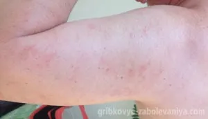 Рожевий лишай на руках причини, симптоми, лікування (симптоми) Рожевий лишай на руках причини, симптоми, лікування
