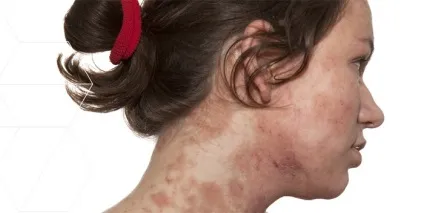 Себорея на обличчі суха і жирна симптоми, причини і лікування дерматиту (причини) Себорея на обличчі суха і жирна симптоми, причини і лікування дерматиту