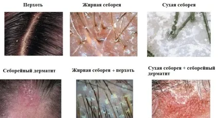 Себорея на обличчі суха і жирна симптоми, причини і лікування дерматиту (причини) Себорея на обличчі суха і жирна симптоми, причини і лікування дерматиту