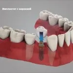 Штіфтовкладка встановлюється в корінь зуба для його відновлення (відновлення зубів) Штіфтовкладка встановлюється в корінь зуба для його відновлення