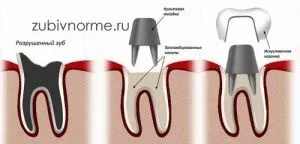 Штифтова культевая вкладка, варіанти, ціни, фото (фото) Штифтова культевая вкладка, варіанти, ціни, фото