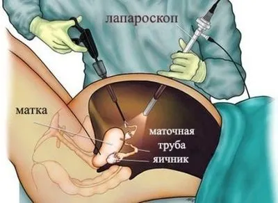 Шоколадна кіста яєчника - як лікувати, причини і симптоми хвороби (причини) Шоколадна кіста яєчника - як лікувати, причини і симптоми хвороби