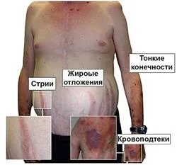 Симптоми захворювань ендокринна системи (залоз внутрішньої секреції) Симптоми захворювань ендокринна системи