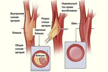 Симптоми атеросклерозу судин нижніх кінцівок і своєчасне лікування (атеросклероз судин нижніх кінцівок симптоми) Симптоми атеросклерозу судин нижніх кінцівок і своєчасне лікування