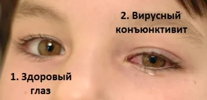 Скільки днів лікується кон'юнктивіт у дітей і дорослих (кон'юнктивіт) Скільки днів лікується кон'юнктивіт у дітей і дорослих