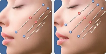 Silhouette lift soft