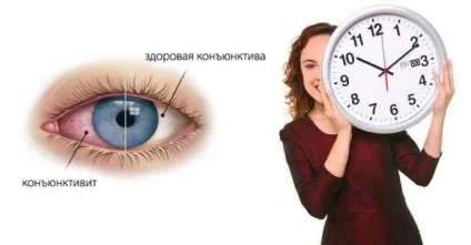 Скільки днів лікується кон'юнктивіт у дітей і дорослих (скільки) Скільки днів лікується кон'юнктивіт у дітей і дорослих