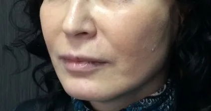 Silhouette lift soft