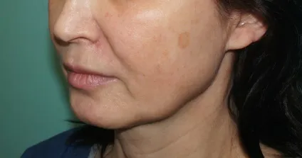 Silhouette lift soft