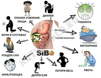 Синдром надлишкового бактеріального росту в тонкому кишечнику (СИБР) (бактеріального) Синдром надлишкового бактеріального росту в тонкому кишечнику (СИБР)
