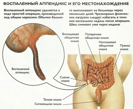 З якого боку апендицит і де він знаходиться, симптоми, лікування (апендицит) З якого боку апендицит і де він знаходиться, симптоми, лікування