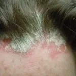 Сіль при псоріазі - ефективна терапія захворювання (псоріаз) Сіль при псоріазі - ефективна терапія захворювання