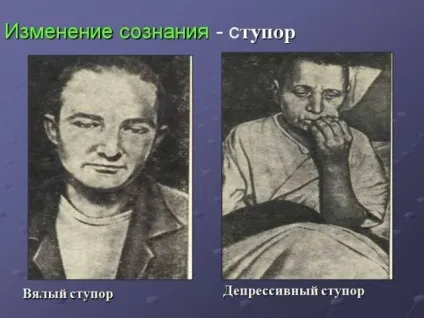 Ступор (заціпеніння, оглушення) кататонический, депресивний, діссоціатівний - симптоми, що