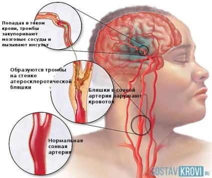 Звуження судин головного мозку причини, симптоми, лікування, народні засоби, у підлітків, (звуження) Звуження судин головного мозку причини, симптоми, лікування, народні засоби, у підлітків,