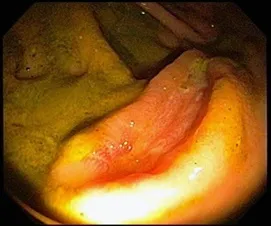 Тифліт - причини, симптоми, класифікація і лікування (лікування) Тифліт - причини, симптоми, класифікація та лікування