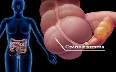 Тифліт кишечника (сліпа кишка) - симптоми, лікування, дієта, народні засоби, гострий, хронічний (кишечника) Тифліт кишечника (сліпа кишка) - симптоми, лікування, дієта, народні засоби, гострий, хронічний
