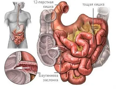 Тифліт (сегментарний коліт) гострий, ерозивний, хронічний - лікування і симптоми (коліт) Тифліт (сегментарний коліт) гострий, ерозивний, хронічний - лікування і симптоми