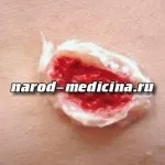 Туляремія симптоми і лікування, секрети народної медицини (симптоми) Туляремія симптоми і лікування, секрети народної медицини