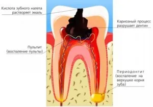 Травматичний періодонтит і його лікування (травматичний) Травматичний періодонтит і його лікування