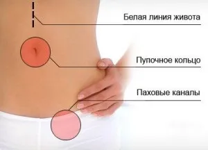 Видалення грижі живота сучасні операції (грижі) Видалення грижі живота сучасні операції
