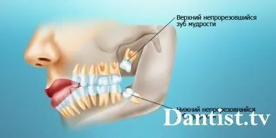 Видалення 8 зуба зверху - знизу ціна і фото (видалення восьмого зуба) Видалення 8 зуба зверху - знизу ціна і фото