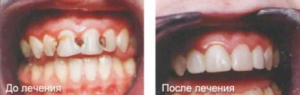 Травматичний періодонтит симптоми, причини, лікування, ціни в москві