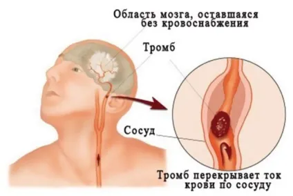 Тромб в голові симптоми і лікування тромбозу головного мозку (голові) Тромб в голові симптоми і лікування тромбозу головного мозку