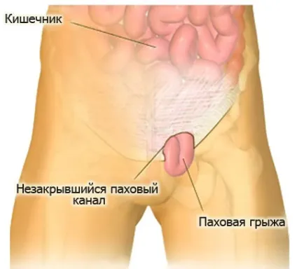 Видалення грижі в москві де можна зробити операцію великий вибір медичних центрів, поліклінік і (видалення пахової грижі) Видалення грижі в москві де можна зробити операцію великий вибір медичних центрів, поліклінік і