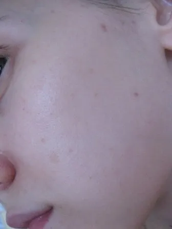 Догляд clinique з серії anti blemish solutions докладно і по поличках відгуки (blemish) Догляд clinique з серії anti blemish solutions докладно і по поличках відгуки