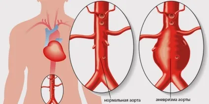 Узі черевної аорти та її гілок підготовка, проведення та розшифровка (гілок) Узі черевної аорти та її гілок підготовка, проведення та розшифровка