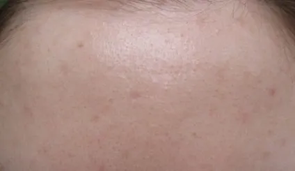 Догляд clinique з серії anti blemish solutions докладно і по поличках відгуки (Свотч) Догляд clinique з серії anti blemish solutions докладно і по поличках відгуки