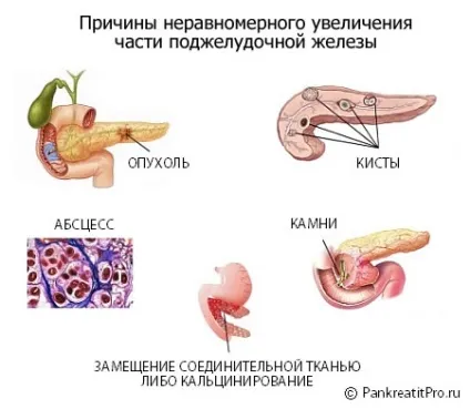 Збільшення підшлункової залози (збільшення підшлункової залози) Збільшення підшлункової залози