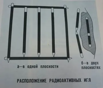 Внутрішньопорожнинна променева терапія (Аплікаційна гамма терапія) Внутрішньопорожнинна променева терапія