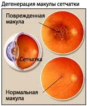 Вікова дегенерація сітківки ока - медичний портал eurolab (вікова дегенерація макули сітківки) Вікова дегенерація сітківки ока - медичний портал eurolab